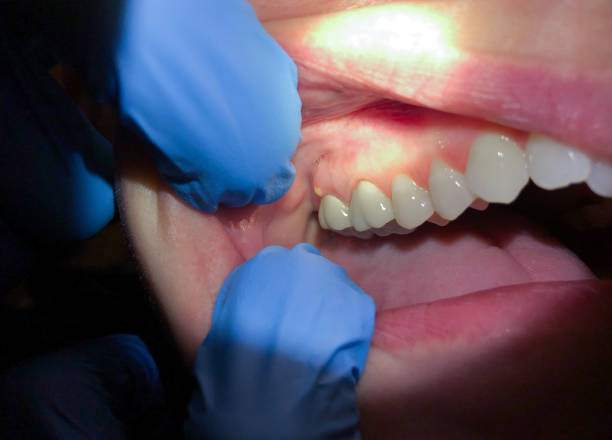 Best Root Canal Emergency Dentist  in Osakis, MN